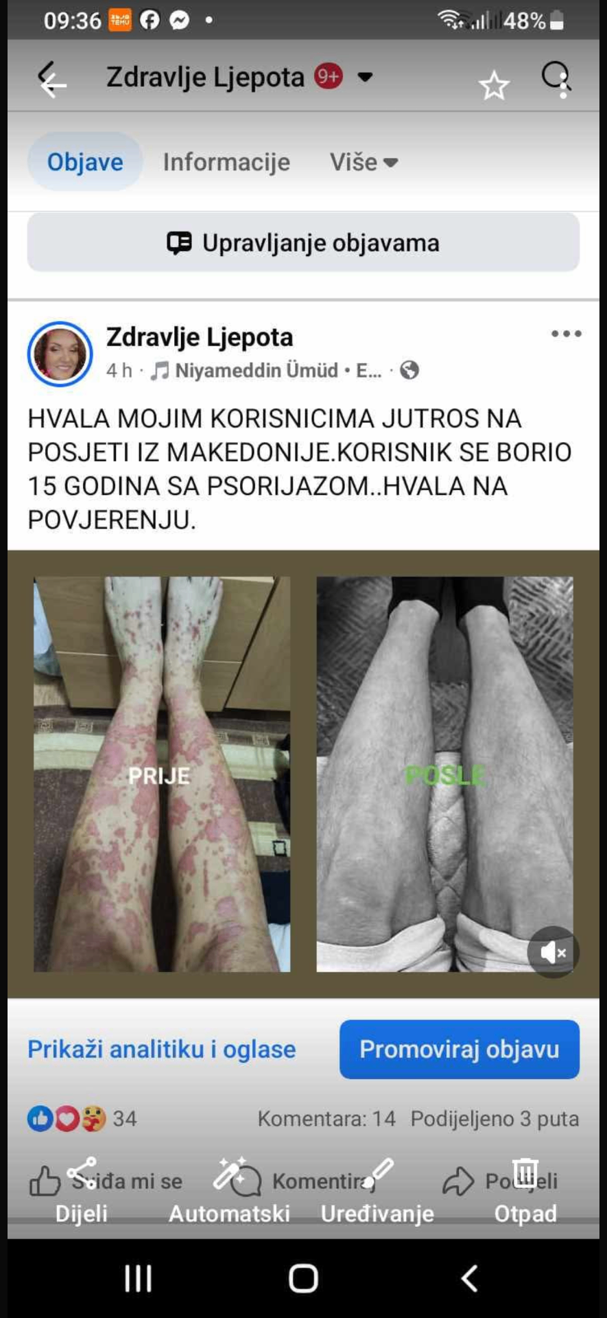 Psorijaza — prije i poslije terapije prirodnim melemom